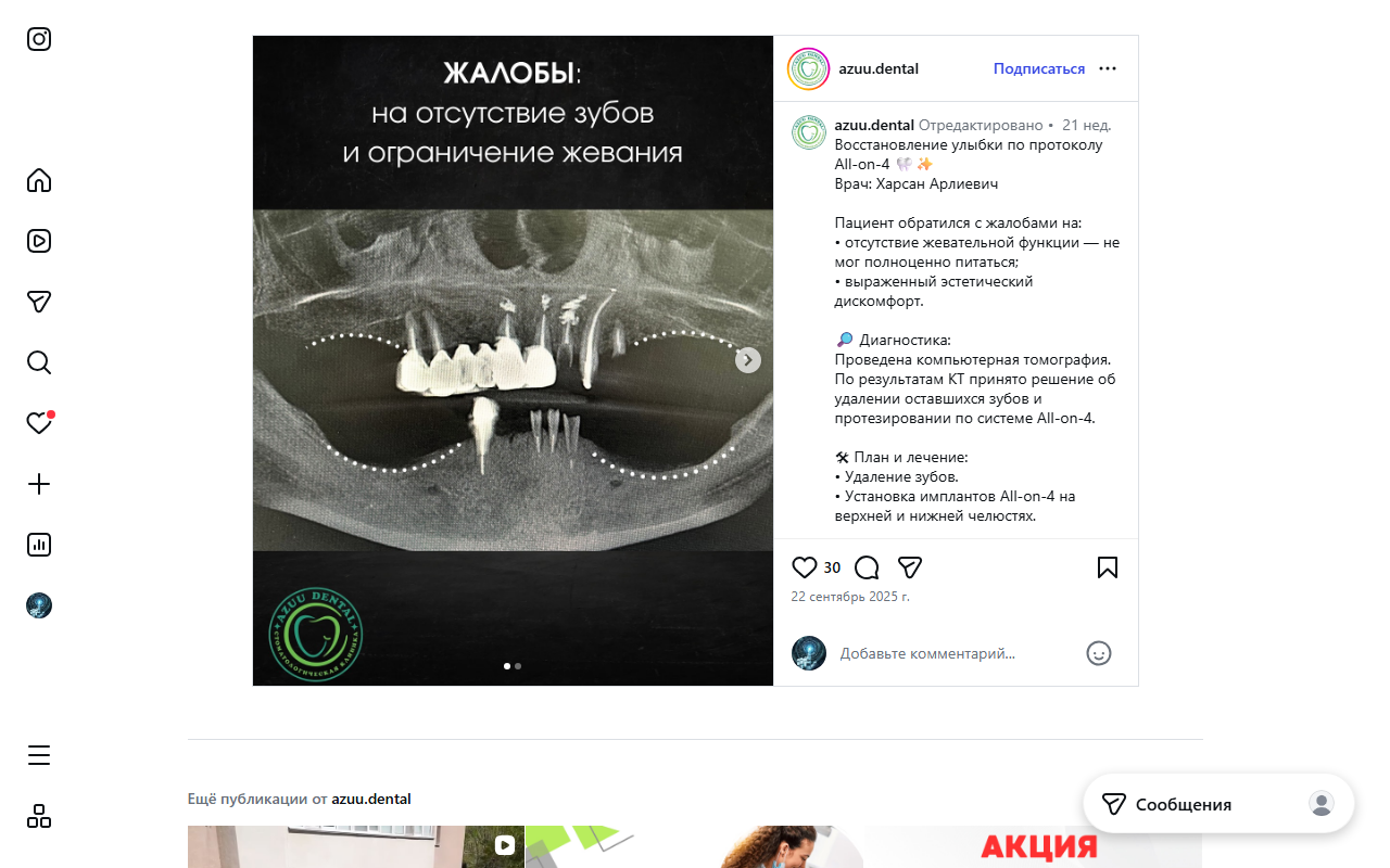 Восстановление All-on-4 — результат