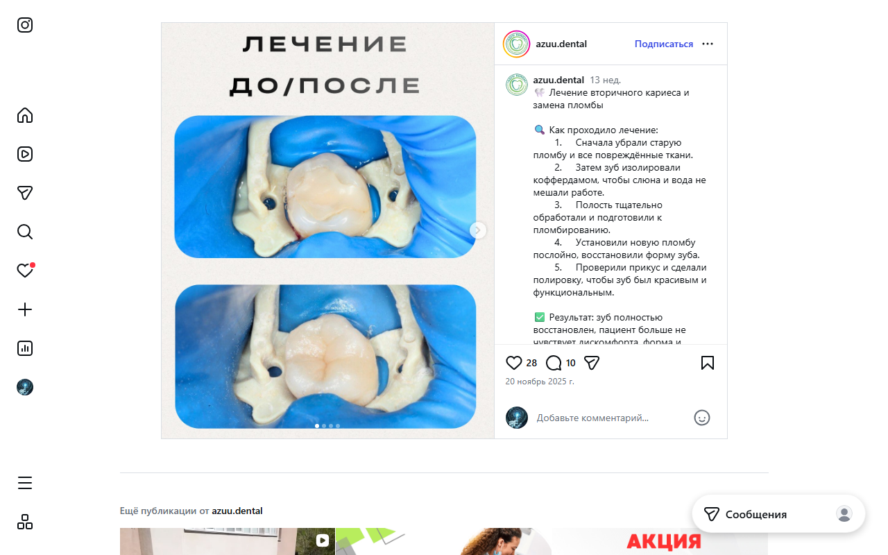 Лечение кариеса — до и после